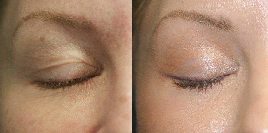 fractitional laser resurfacing los angeles