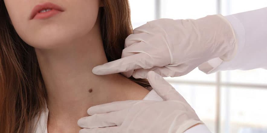 skin cancer signs