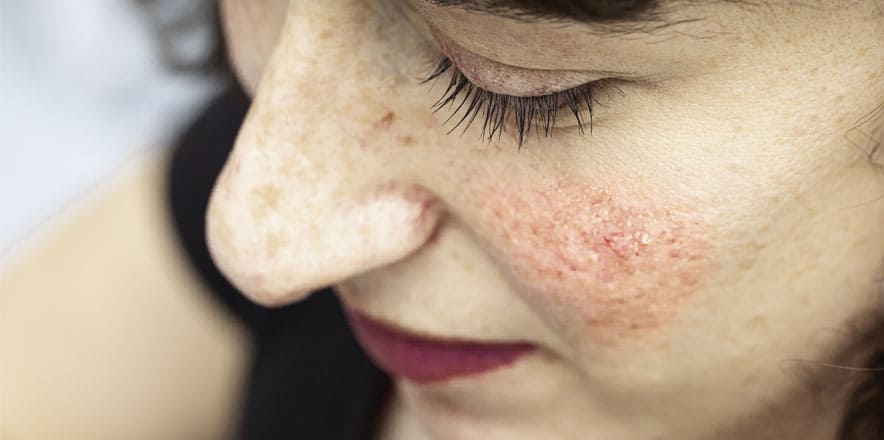 acne rosacea treatment