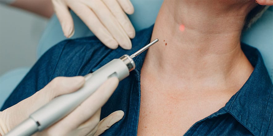 remove age spots los angeles dermatologist copy