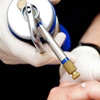 Cryotherapy wart removal 1
