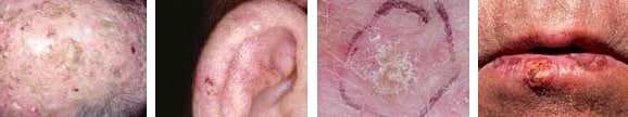 actinic keratoses symptoms images