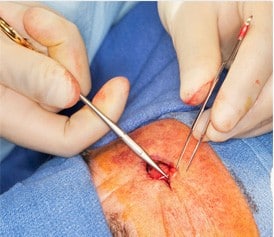 Excisional surgery: gloved hands removing a skin lesion with surgical instruments