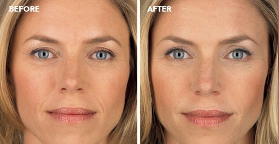 juvederm before after