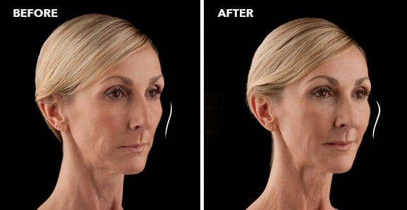 juvederm voluma xc before after