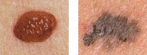 melanoma borders