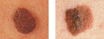 melanoma colors