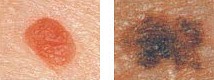 melanoma diameter