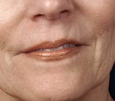 microneedling anti aging before pic