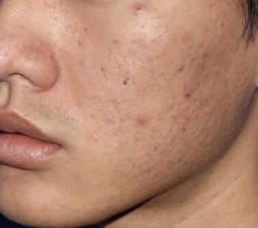 microneedling before acne before pic 2