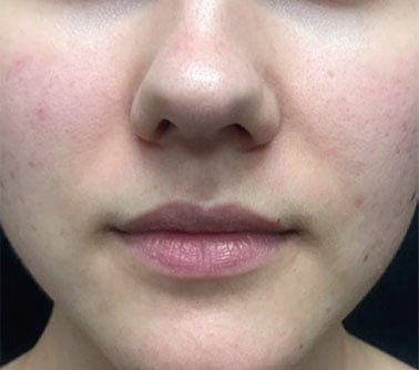 microneedling before acne pic