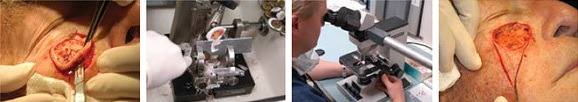 mohs micrographic surgery