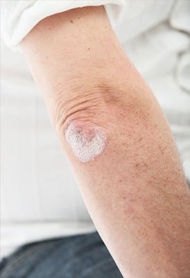 psoriasis treatment
