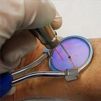 image of the yag laser treating leg veins