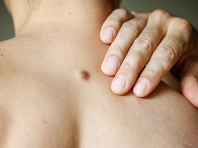 Fibroma on the male back details close up (1)