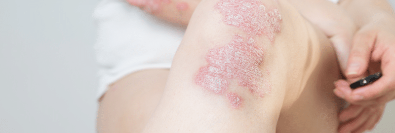 Finding a Psoriasis Expert in Los Angeles, CA