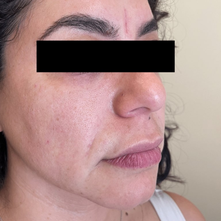 After Image: Facial Filler and Botox - right-front-oblique