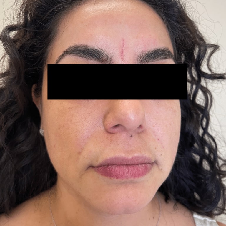 After Image: Facial Filler and Botox - front