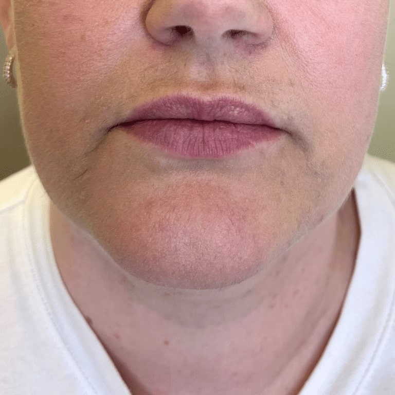 Before Image: Lip Filler - front