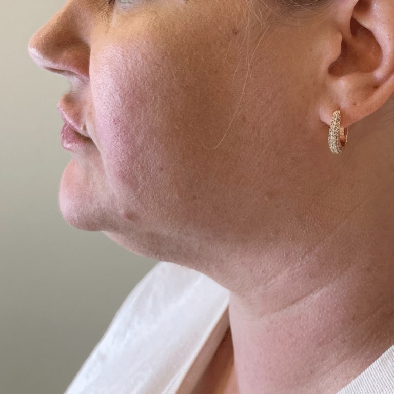 After Image: Lip Filler - left-side